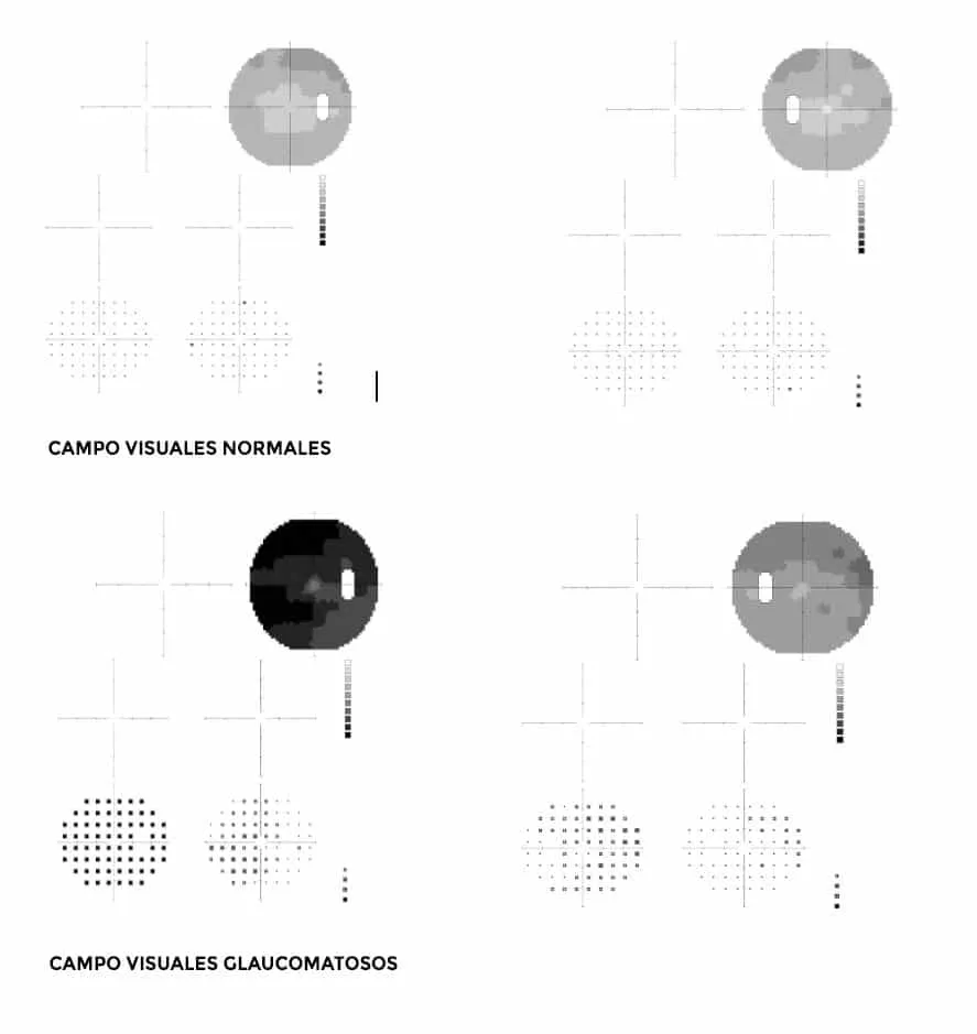 diagnostico del glaucoma: campimetria