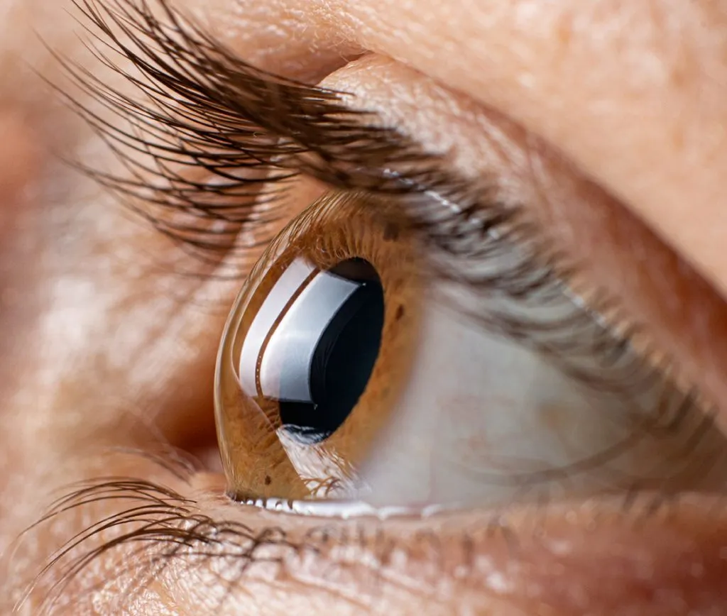 tratamiento queratocono fuengirola mijas