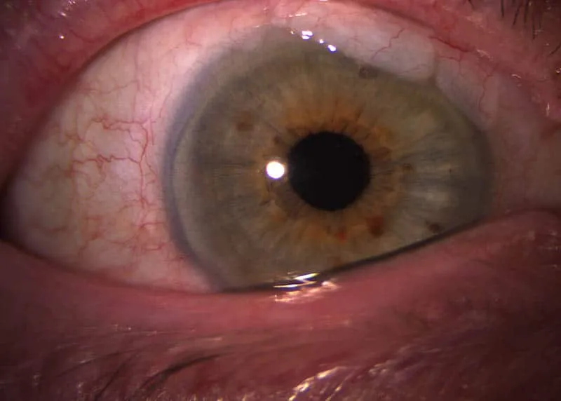 revision-glaucoma-fuengirola