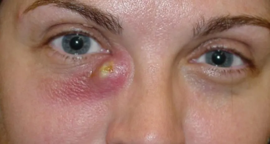 tratamiento-dacriocistitis fuengirola mijas