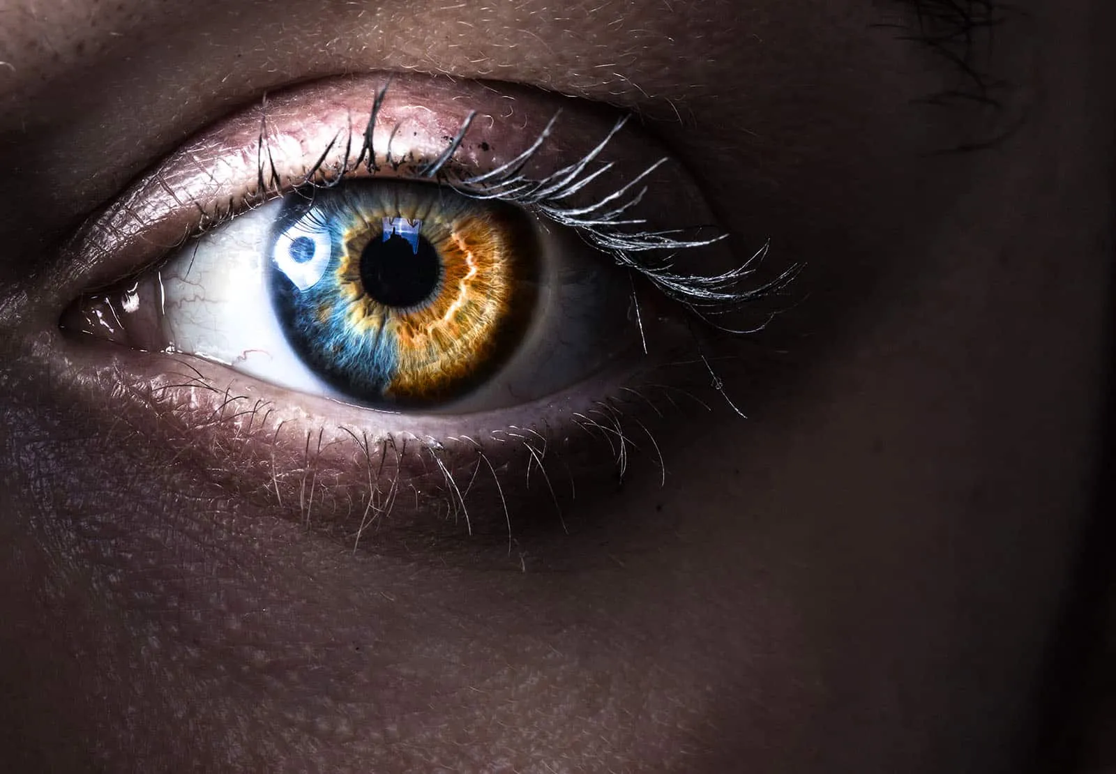 heterocromía causas y tipos