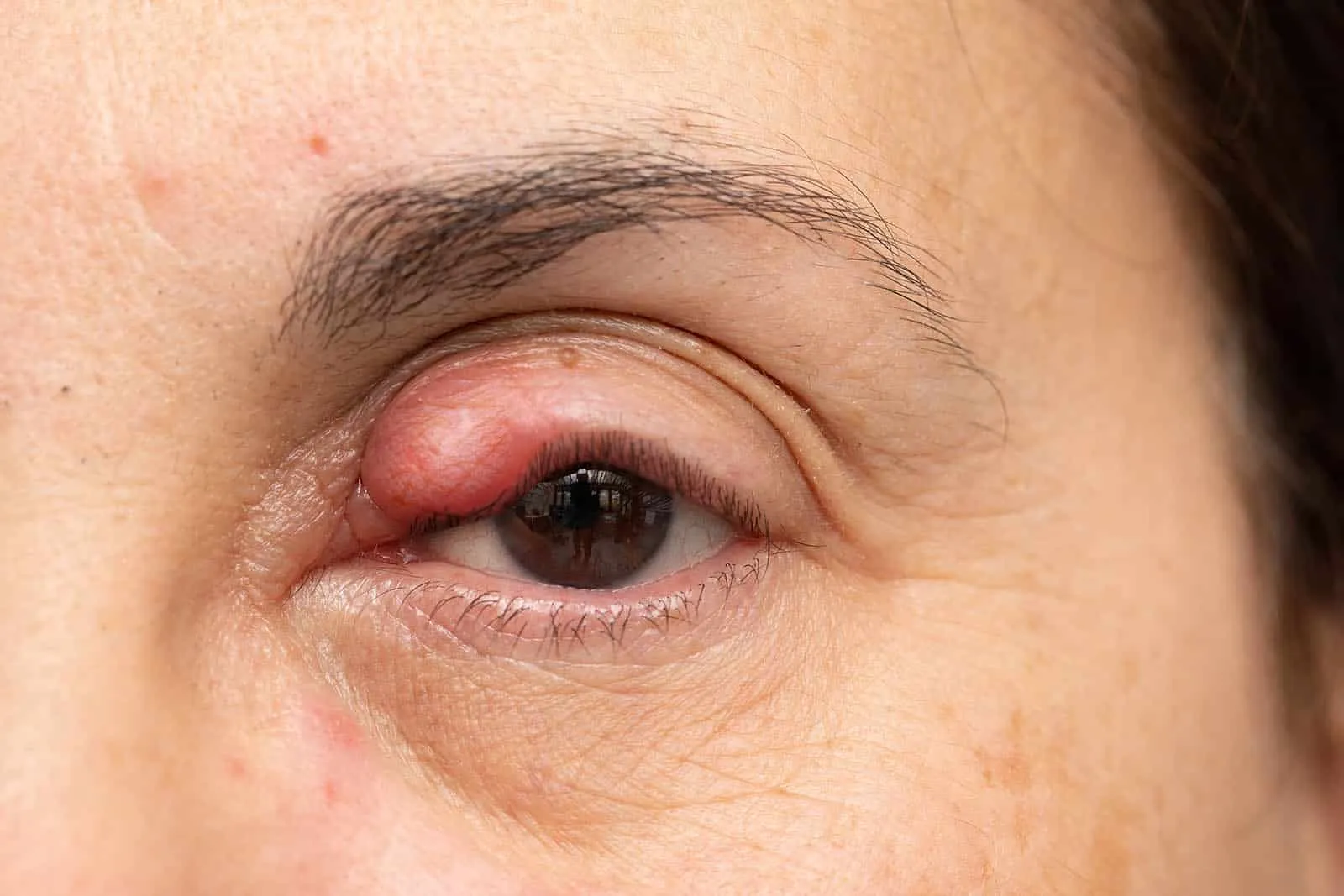 Chalazion tratamiento en fuengirola