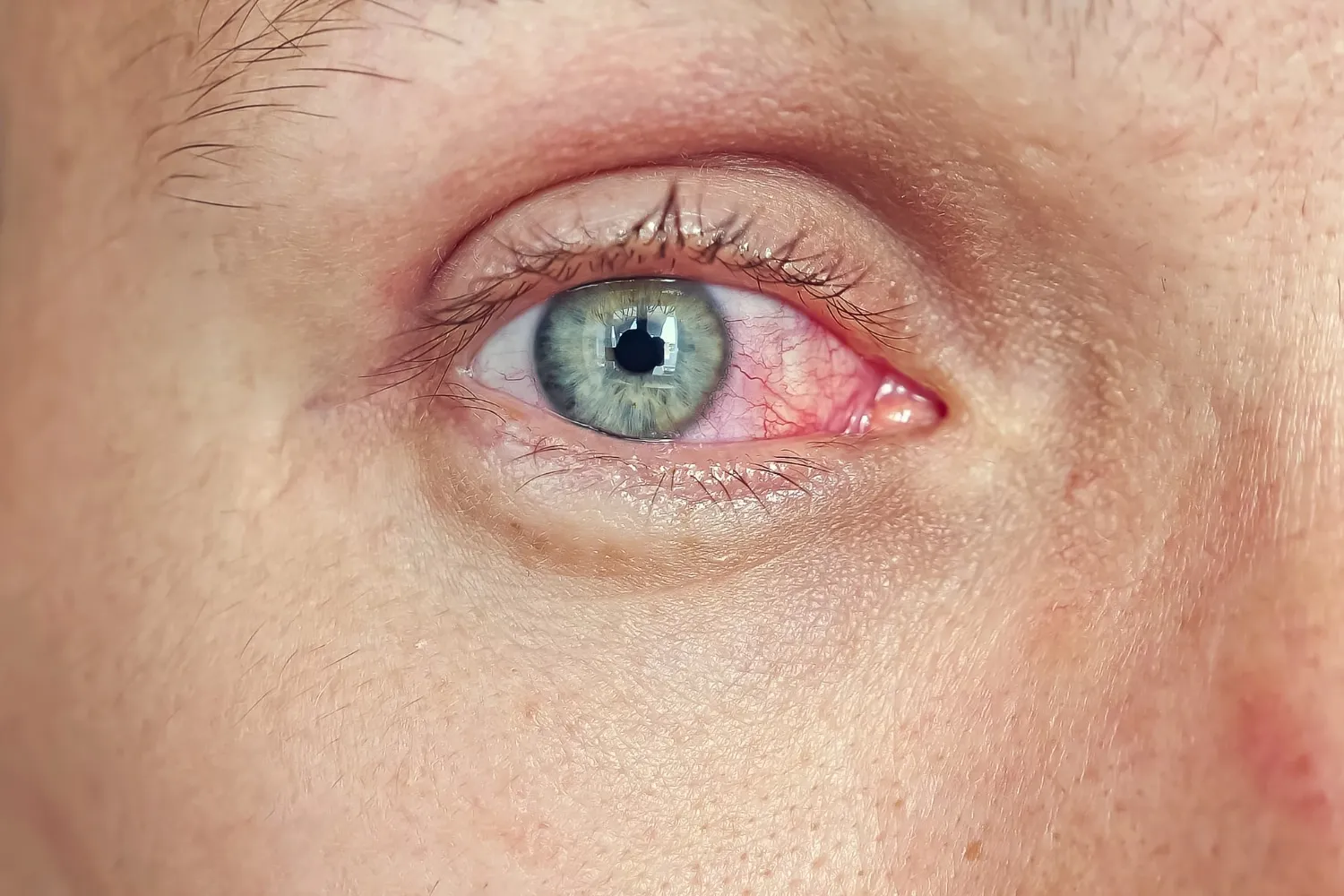 Hiperemia Conjuntival Fuengirola
