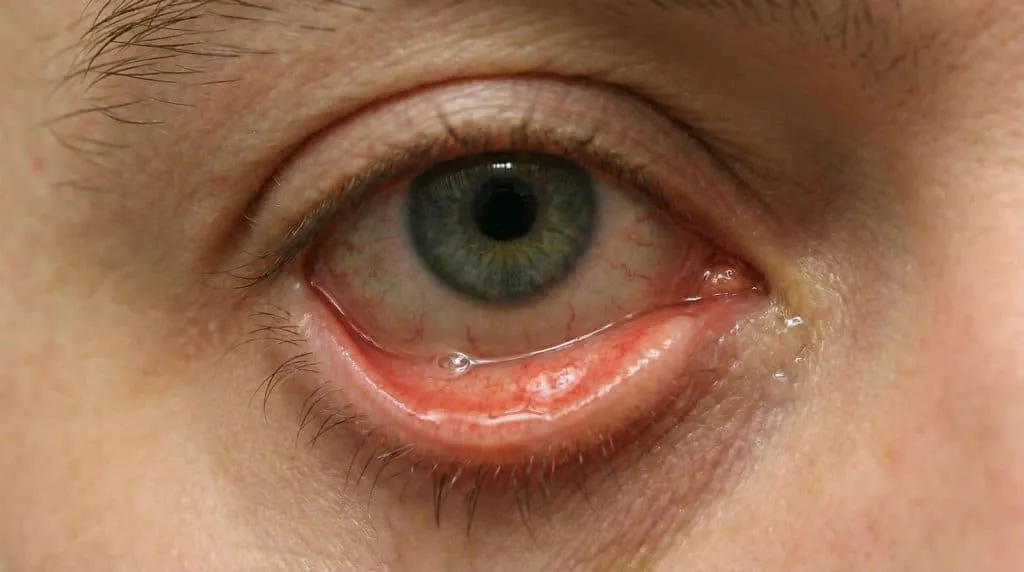 árpado inferior descolgado por ectropión en paciente adulto